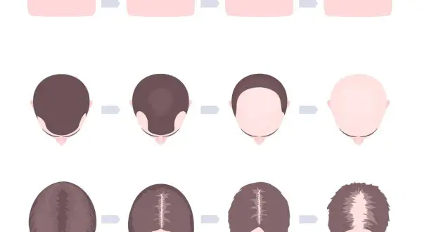 Ilustracja pokazuje postępujące łysienie plackowate u dzieci, od pełnych włosów do całkowitej utraty.