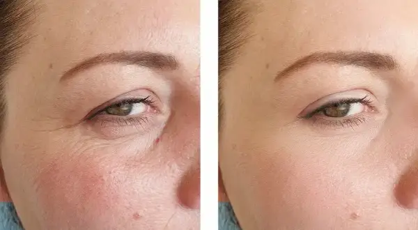 Comparaison avant/après : la peau ridée à gauche est lissée à droite, montrant l'efficacité du tretinoin vs retinol pour réduire les rides.
