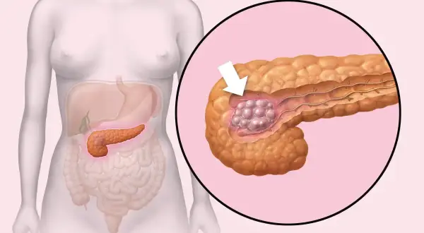 Ilustracja pokazuje trzustkę z guzem. Pytanie "rak trzustki ile się żyje" jest kluczowe dla pacjentów.
