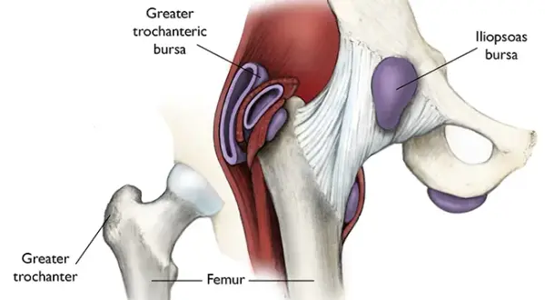 Causas y tratamientos del dolor en los músculos de la cadera