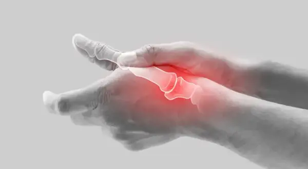 Schmerzende Hand mit gerötetem processus styloideus radii.