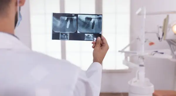 Dentysta analizuje RTG zęba z implantem, zastanawiając się, ile kanałów ma 5.