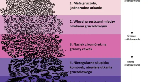 Skala Gleasona ilustruje stopnie zróżnicowania komórek w **adenocarcinoma prostatae gleason 7 (3+4)**, od małych gruczołów po naciek komórek.