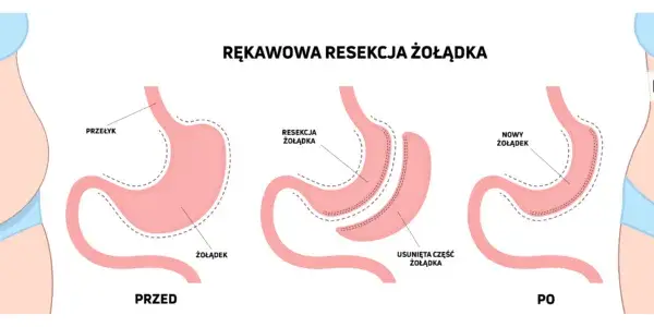 Operacja zmniejszenia żołądka na NFZ - gdzie i jak się kwalifikować