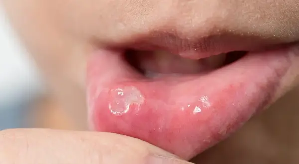 Wizyta u dentysty z aftą: Kiedy tak, a kiedy lepiej poczekać?