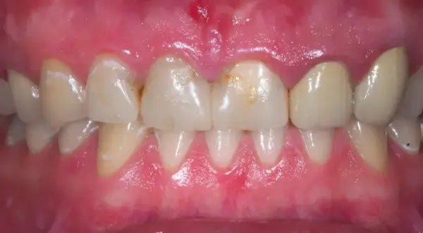 Podrażnione dziąsła: Szybka ulga i trwałe rozwiązanie. Kiedy do dentysty?