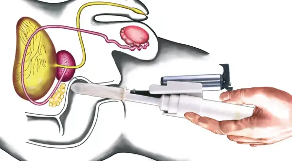 Darstellung der radikalen Prostatektomie: Ein chirurgisches Instrument wird eingeführt, um die Prostata zu entfernen.