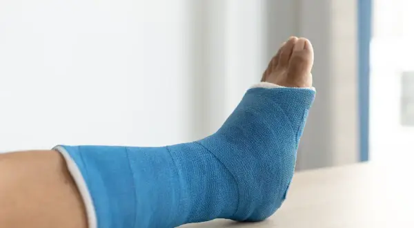 Niebieski opatrunek gipsowy na stopie i nodze, przygotowanie do rehabilitacji po usunięciu zespolenia z kostki.