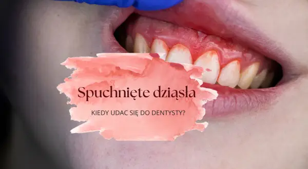 Spuchnięte dziąsło: Szybka ulga, przyczyny i kiedy do dentysty?