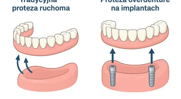 Porównanie protezy ruchomej i protezy na implantach. Prawidłowa higiena jamy ustnej po wszczepieniu implantu jest kluczowa.