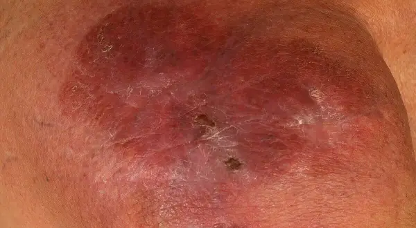 Hautläsionen, die auf multiples Myelom hindeuten. Rötliche, geschwollene Stelle mit schuppiger Oberfläche und kleinen Krusten.
