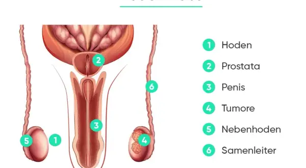 Anatomische Darstellung des männlichen Genitalbereichs mit Markierungen für Hoden, Prostata, Penis, Tumore, Nebenhoden und Samenleiter. Wichtige Informationen zur Hodenkrebs Therapie.