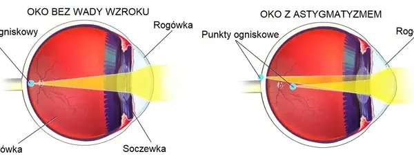 Astygmatyzm u dorosłych: Czy ustępuje? Poznaj metody korekcji