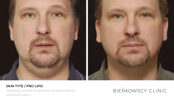 Przed i po zabiegu redukcji tkanki tłuszczowej. Widoczne lipoliza ud efekty, poprawa konturu twarzy i napięcie skóry.