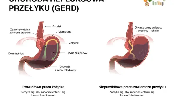Dieta na refluks: Skuteczne zasady i jadłospis dla Twojej ulgi