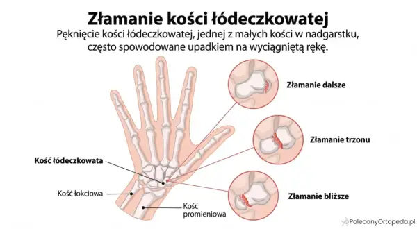 Ilustracja anatomiczna dłoni z zaznaczonymi złamaniami kości łódeczkowatej.