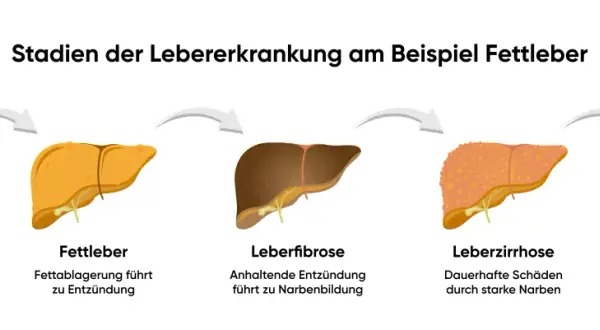 Verlauf einer Lebererkrankung: gesunde Leber, Fettleber, Leberfibrose, Leberzirrhose und Leberkrebs. Stres oksydacyjny kann diese Entwicklung beschleunigen.