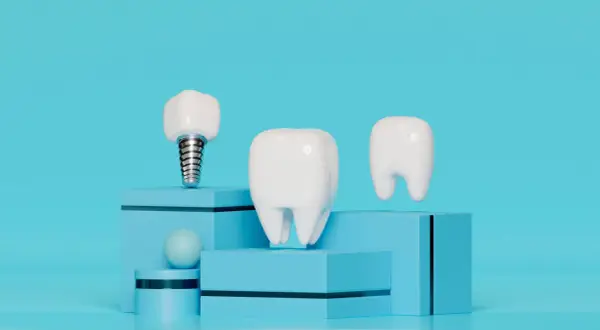 Un implante dental junto a dientes, sobre cubos azules.