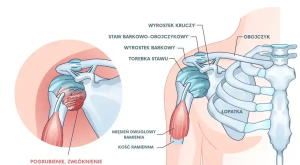 Ilustracja przedstawia zamrożony bark, z zaznaczonym pogrubieniem i zwłóknieniem torebki stawu, co powoduje ból barku.