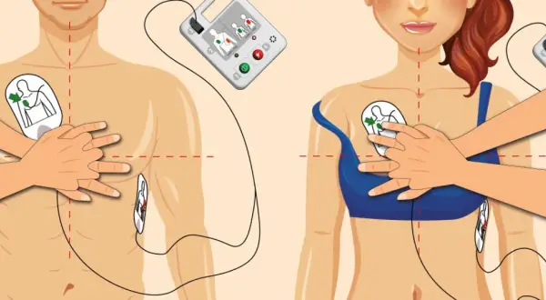 Ilustracja pokazuje, jak działa defibrylator: elektrody przyklejane są do klatki piersiowej, a urządzenie analizuje rytm serca.