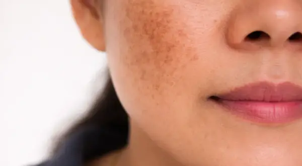 Zbliżenie na twarz kobiety z przebarwieniami na policzku. Czy to melasma? To pytanie zadaje sobie wiele osób z podobnymi zmianami skórnymi.