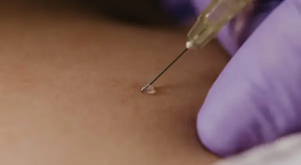 Gros plan sur une aiguille fine pour une infiltration du dos, une goutte de liquide prête à être injectée.
