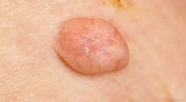 Kłykciny kończyste: do dermatologa, urologa czy ginekologa?