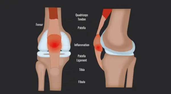 Entzündung der Patella Sehne am Kniegelenk, mit Femur, Patella und Tibia.
