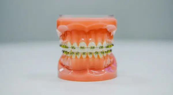 Model szczęki z aparatami ortodontycznymi, ilustrujący proces ekwilibracji zgryzu.