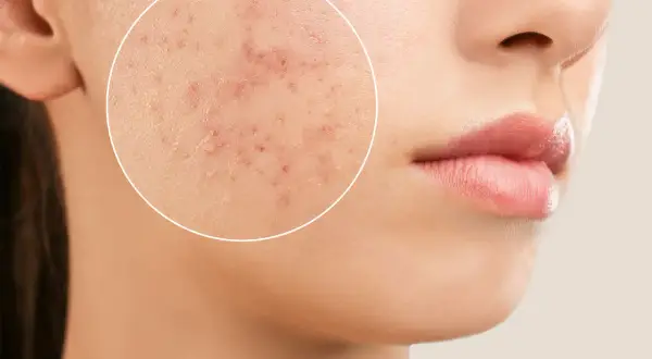 Gros plan sur une joue montrant des rougeurs et des imperfections, rappelant l'acné à 50 ans chez un homme.