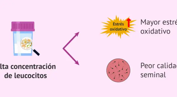 Recipiente con alta concentración de leucocitos, que indica mayor estrés oxidativo y peor calidad seminal.