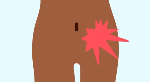 Illustration d'une zone du corps humain montrant une douleur vive au pubis côté droit, symbolisée par une étoile rouge éclatante.