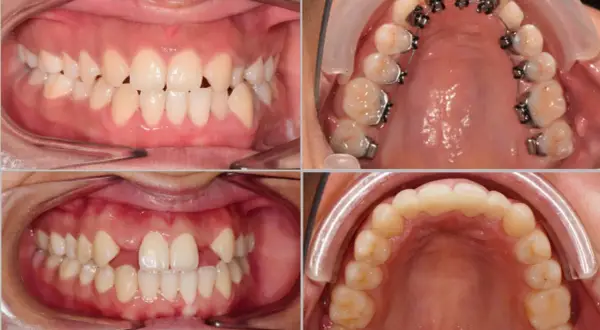 Denti con agenesia dentale, alcuni con apparecchio ortodontico per correggere gli spazi vuoti.
