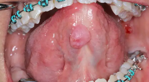 Lingua con apparecchio ortodontico e una piccola ranula, una lesione benigna.