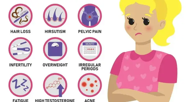 Grafika przedstawia zespół policystycznych jajników objawy: wypadanie włosów, nadmierne owłosienie, ból miednicy, niepłodność, nadwagę, nieregularne miesiączki, zmęczenie, wysoki poziom testosteronu, trądzik.