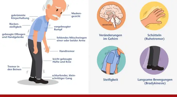Illustration zeigt Parkinson-Symptome: gekrümmte Haltung, Tremor, Steifigkeit, veränderter Gang und Gehirnveränderungen.