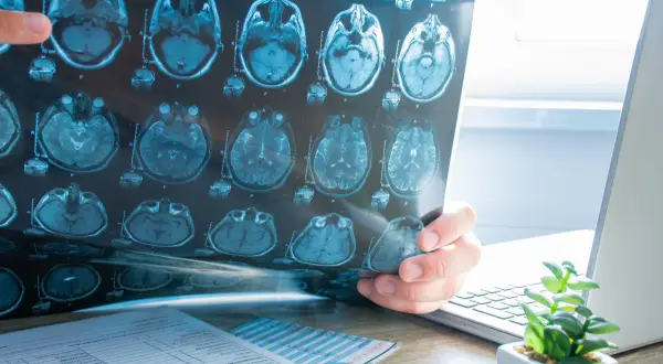 Un médecin examine un IRM cérébral, cherchant des indices sur l'oreille interne.
