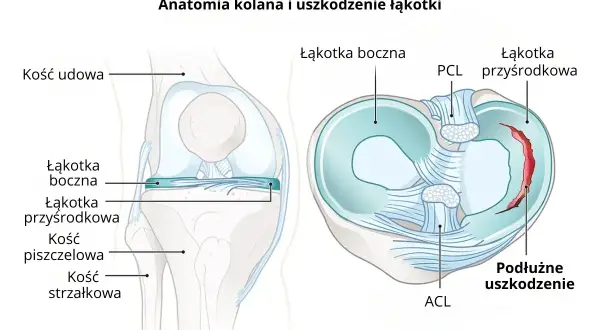 Ilustracja anatomii kolana z zaznaczonymi elementami, w tym uszkodzoną łąkotką przyśrodkową.