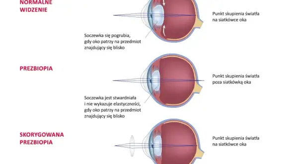 Ilustracja porównująca normalne widzenie, prezbiopię i skorygowaną prezbiopię, pokazująca skupienie światła w oku.