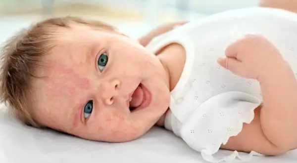 Söt bebis med blå ögon och lite babyakne på kinderna, glad och skrattande.