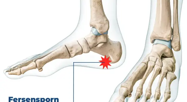 Knochenmodell eines Fußes mit hervorgehobenem Fersensporn hinten, der Schmerzen an der Plantarfaszie verursacht.
