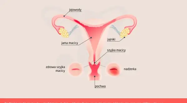 Ilustracja przedstawia anatomię kobiecych narządów rozrodczych z zaznaczoną nadżerką szyjki macicy, która jest wrzodziejącym ubytkiem.
