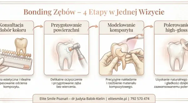 Bonding zębów: konsultacja, przygotowanie, modelowanie kompozytu i polerowanie. Zabieg nie niszczy zębów, a jedynie je upiększa.