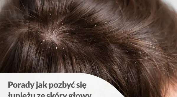 Widoczny łupież na czubku głowy, wśród ciemnych włosów. Białe płatki osiadły na skórze i włosach, tworząc nieestetyczny widok.