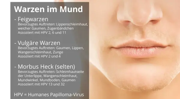 Informationen zu HPV im Mund: Feig-, vulgäre und Morbus Heck-Warzen. Erfahren Sie mehr über die Ursachen und Symptome.