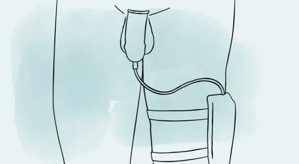 Illustration zeigt, wie man ein Urinalkondom anlegt. Ein Schlauch verbindet das Kondom mit einem Auffangbeutel am Bein.
