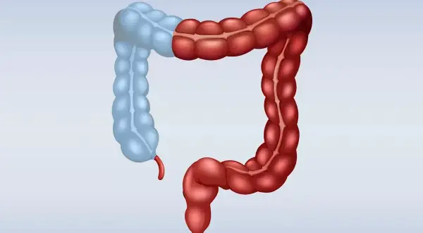 Ilustracja jelita grubego, gdzie prawa strona (czerwona) jest połączona z lewą (niebieską), symbolizując stan po hemikolektomii prawostronnej.