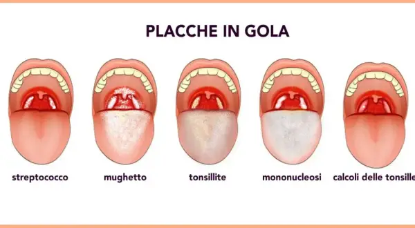 Illustrazione di cinque bocche aperte che mostrano diverse condizioni della gola, tra cui placche e calcoli tonsillari.