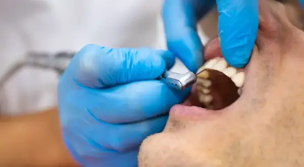 Dentysta w niebieskich rękawiczkach używa wiertła stomatologicznego do leczenia zęba, który może być dotknięty zatruciem.