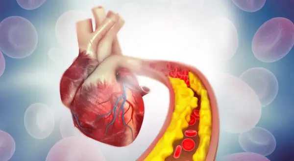 Serce z zatkanym naczyniem krwionośnym, gdzie cholesterol nie-HDL tworzy żółte złogi, utrudniając przepływ czerwonych krwinek.